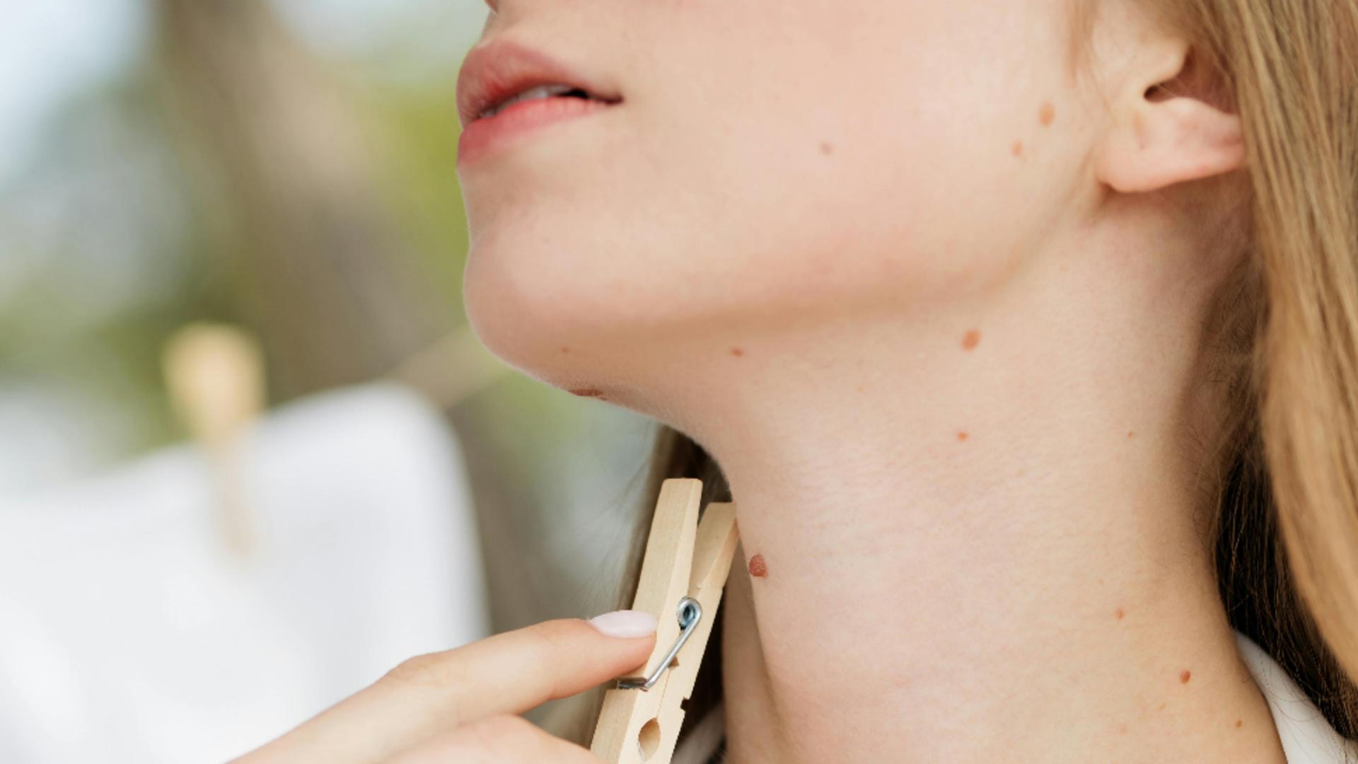 Ce semnificație au alunițele de pe frunte. Semnele din naștere dau indicii despre destinul tău