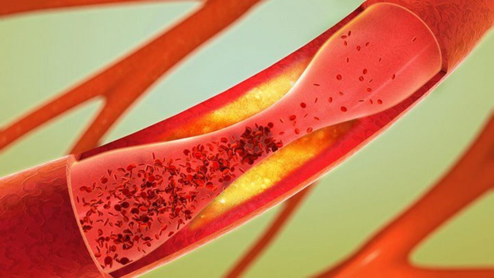 Cum poți preveni formarea cheagurilor de sânge, această afecțiune care poate fi mortală. Sfaturi importante de care TREBUIE să ții cont