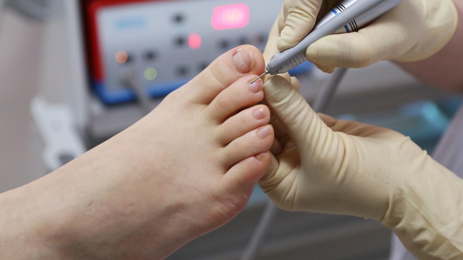 Cum poți trata ciuperca unghiei, în mod natural și repede. Primele semne ale onicomicozei