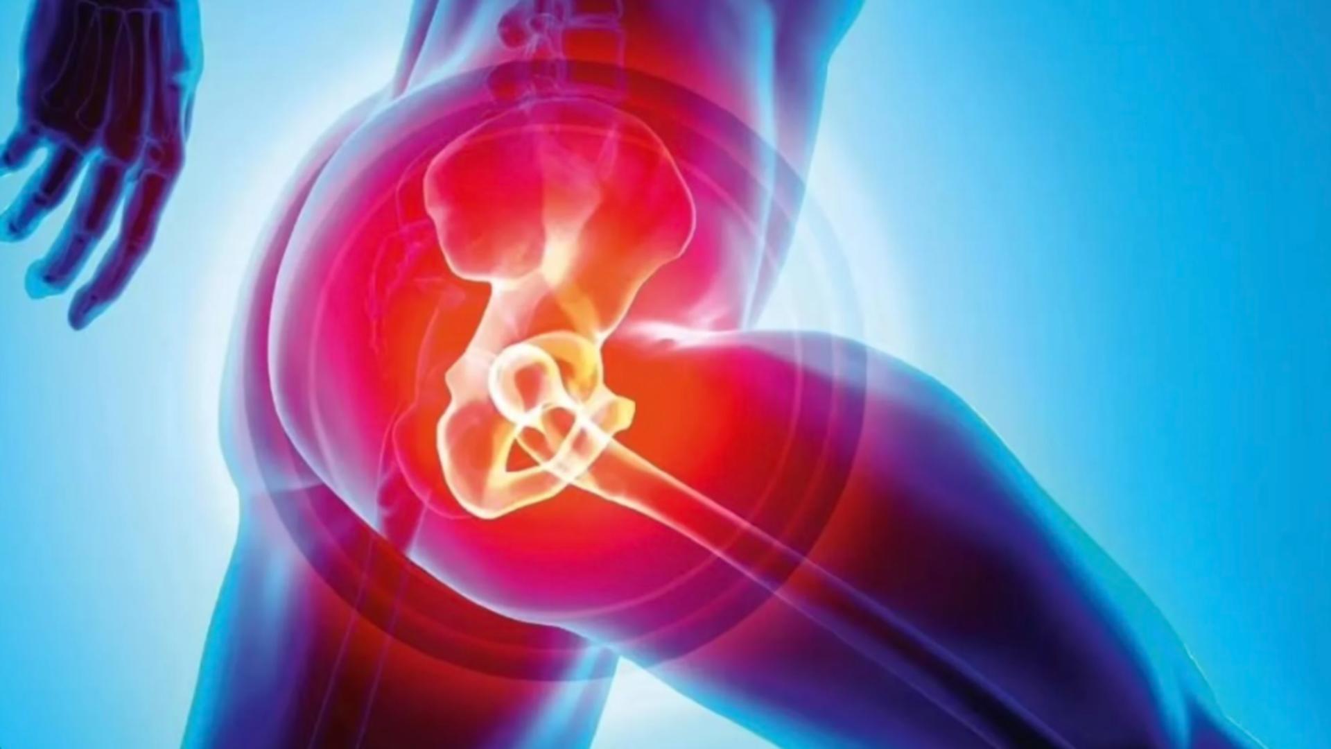 Cum se tratează artroza șoldului