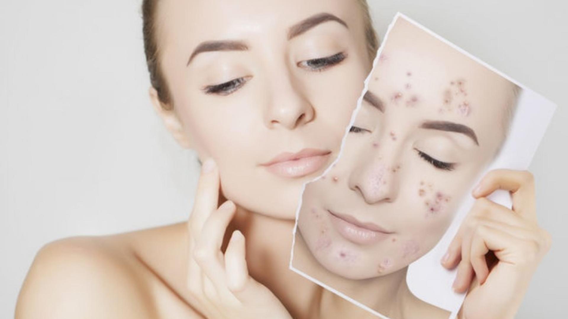 Trucul natural care te scapă de acnee