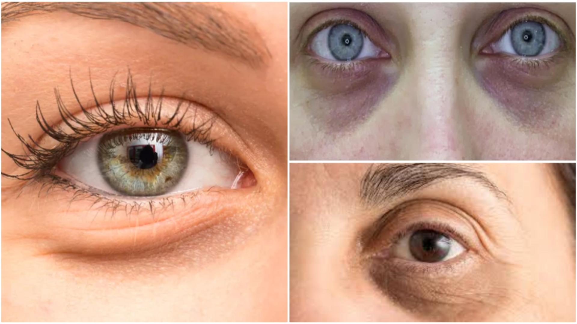 Boala care se ascunde în spatele cearcănelor. 