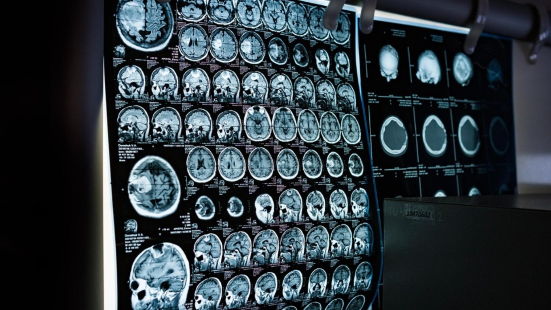 Ce este examenul PET-CT