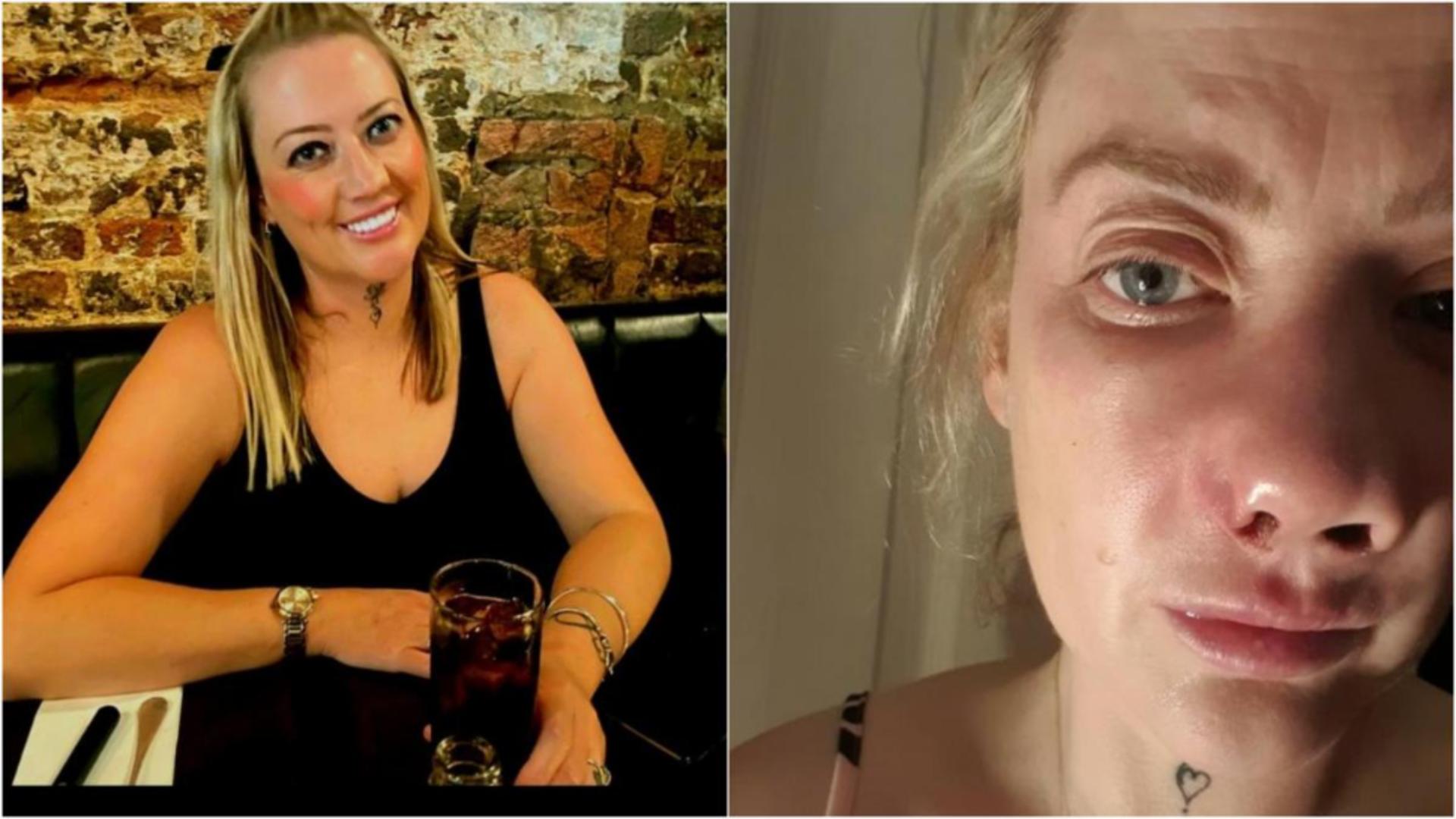 Un coșmar în loc de zâmbet: drama unei femei desfigurate după un tratament dentar ieftin în Turcia