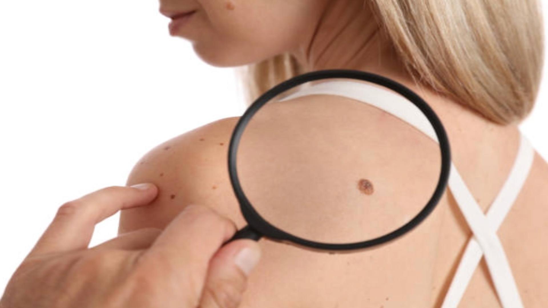 Cum apare cancerul de piele