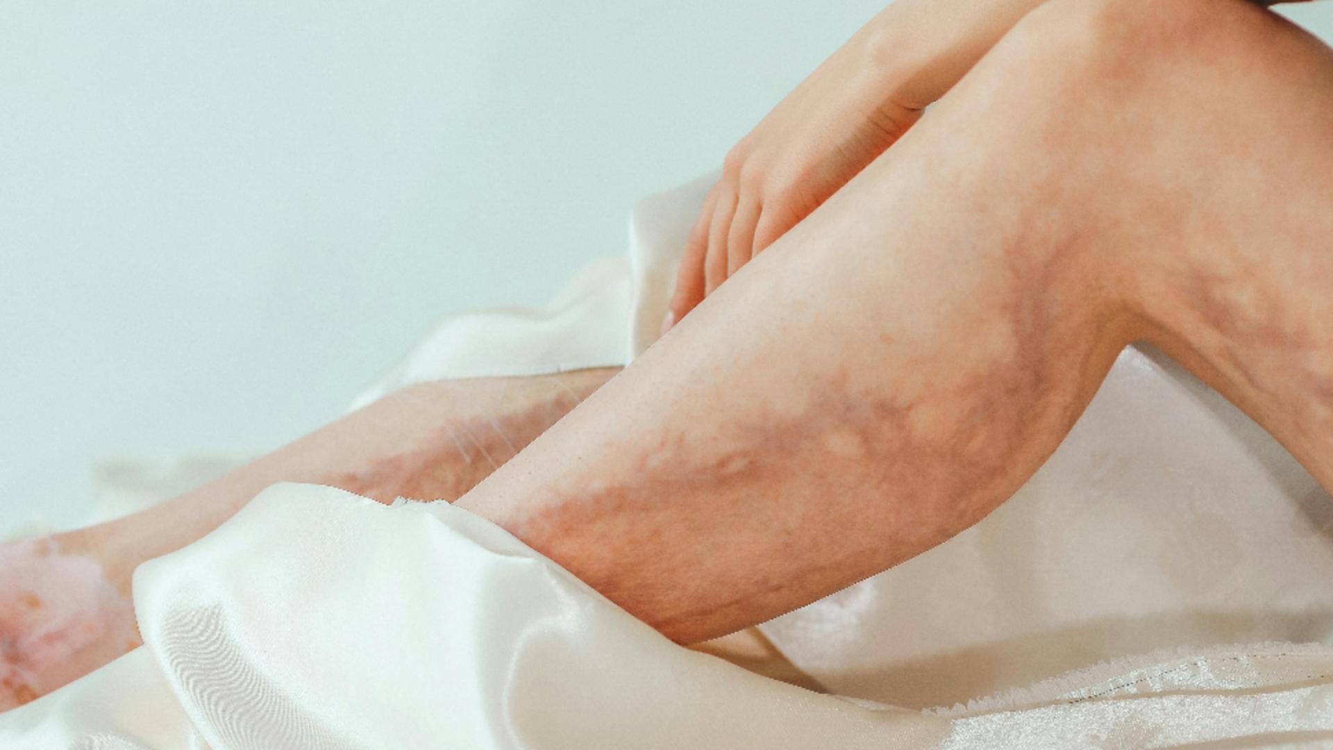 Amestecul preparat în casă din 3 ingrediente. Stimulează circulația sangvină și reduce varicele