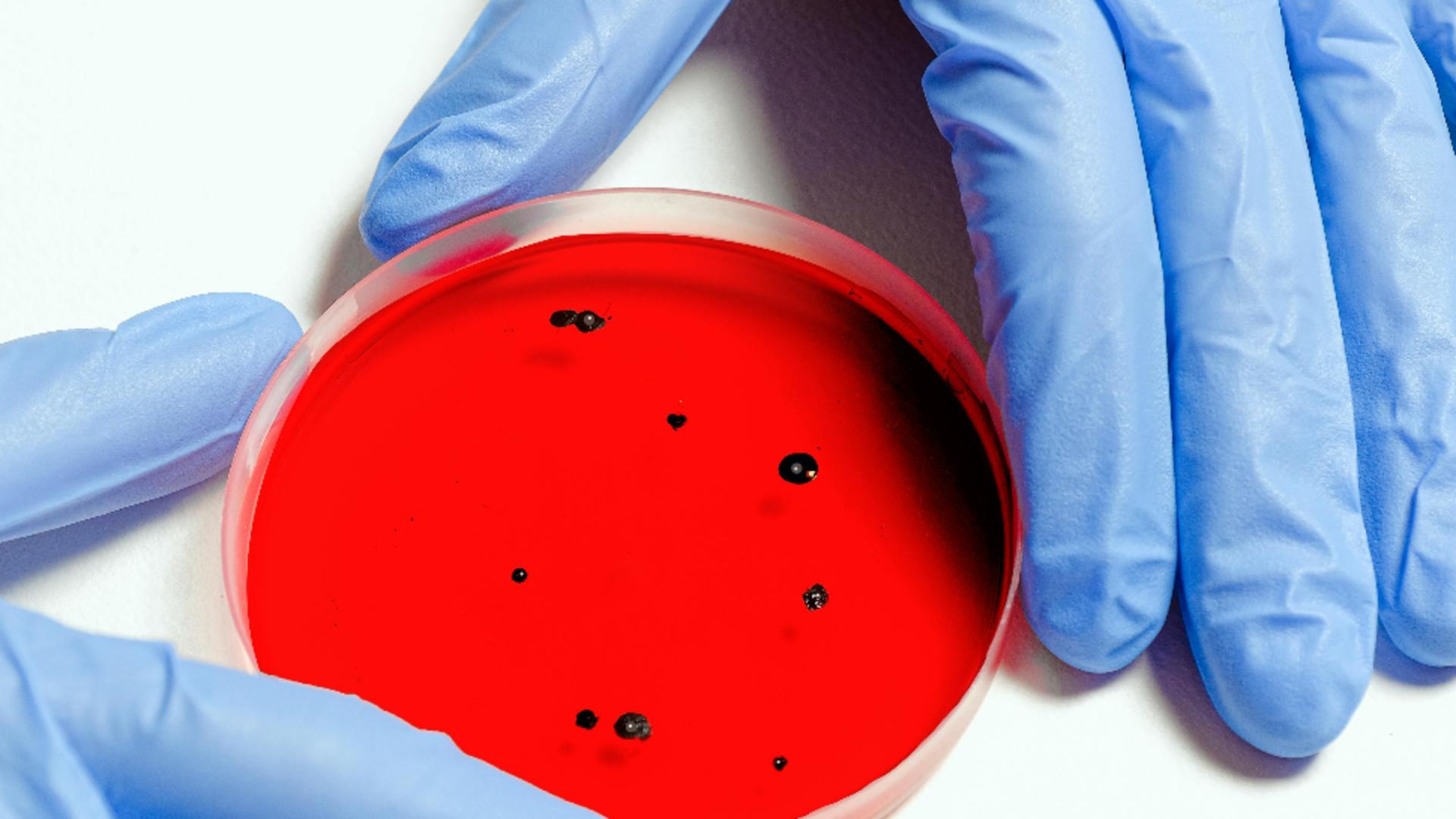 Ce este ANTRAXUL, infecția care poate afecta grav oamenii. Cum se transmite și ce simptome are "buba neagră"