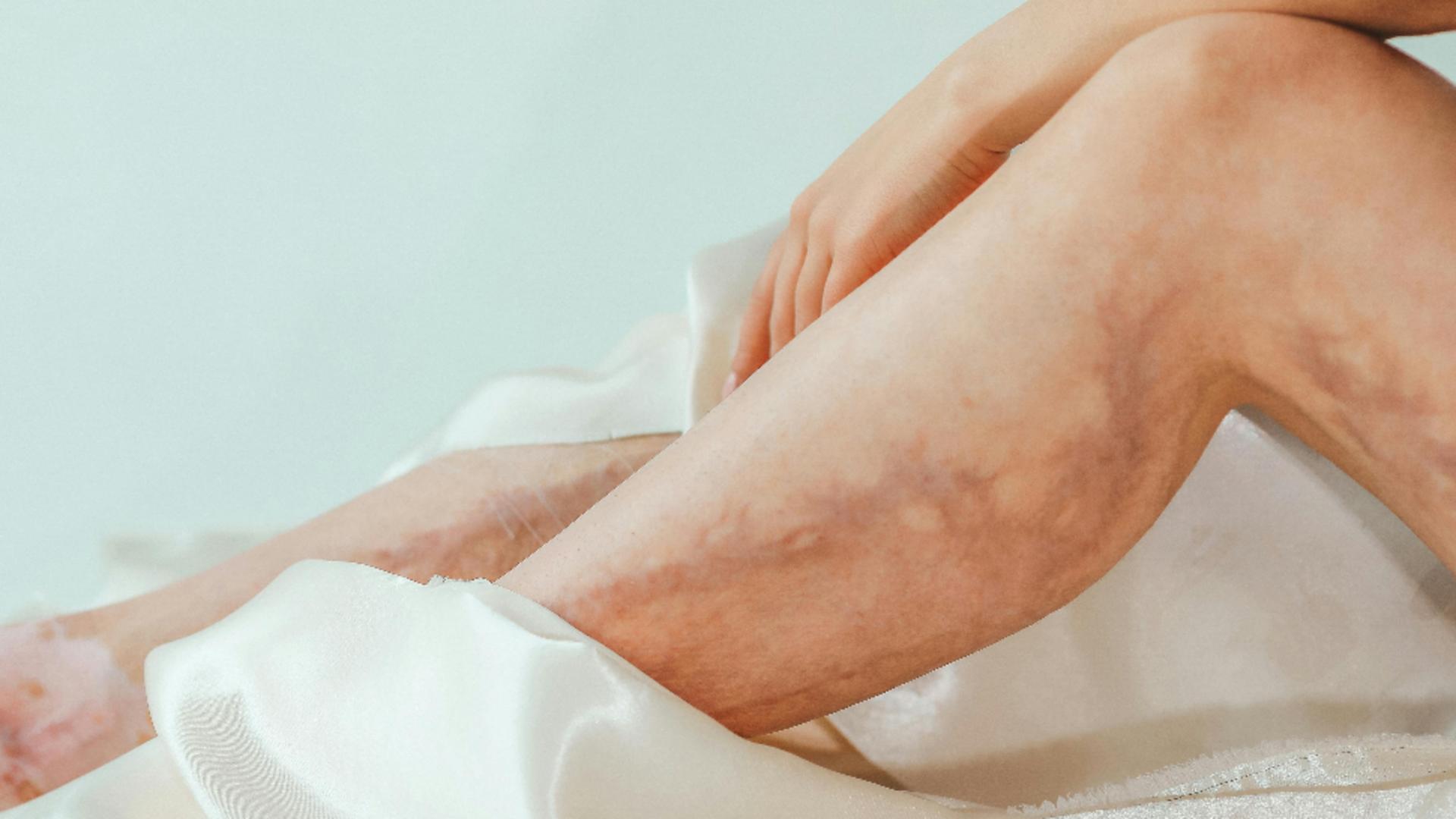 Cum să scapi de varice cu ajutorul acestei plante. Rețeta recomandată de fitoterapeuți