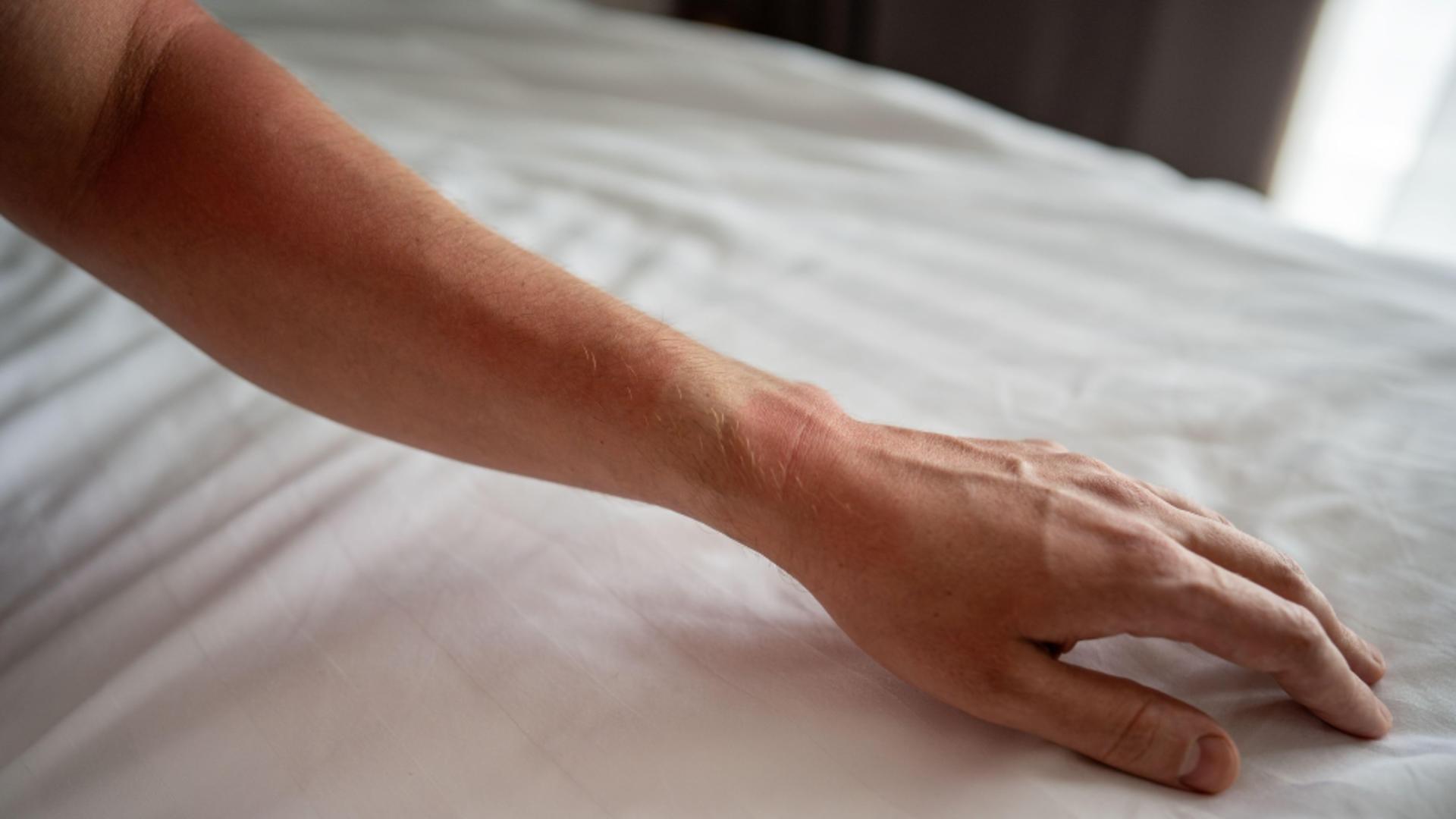 Cum se manifestă alergia la soare/ Foto: Profimedia