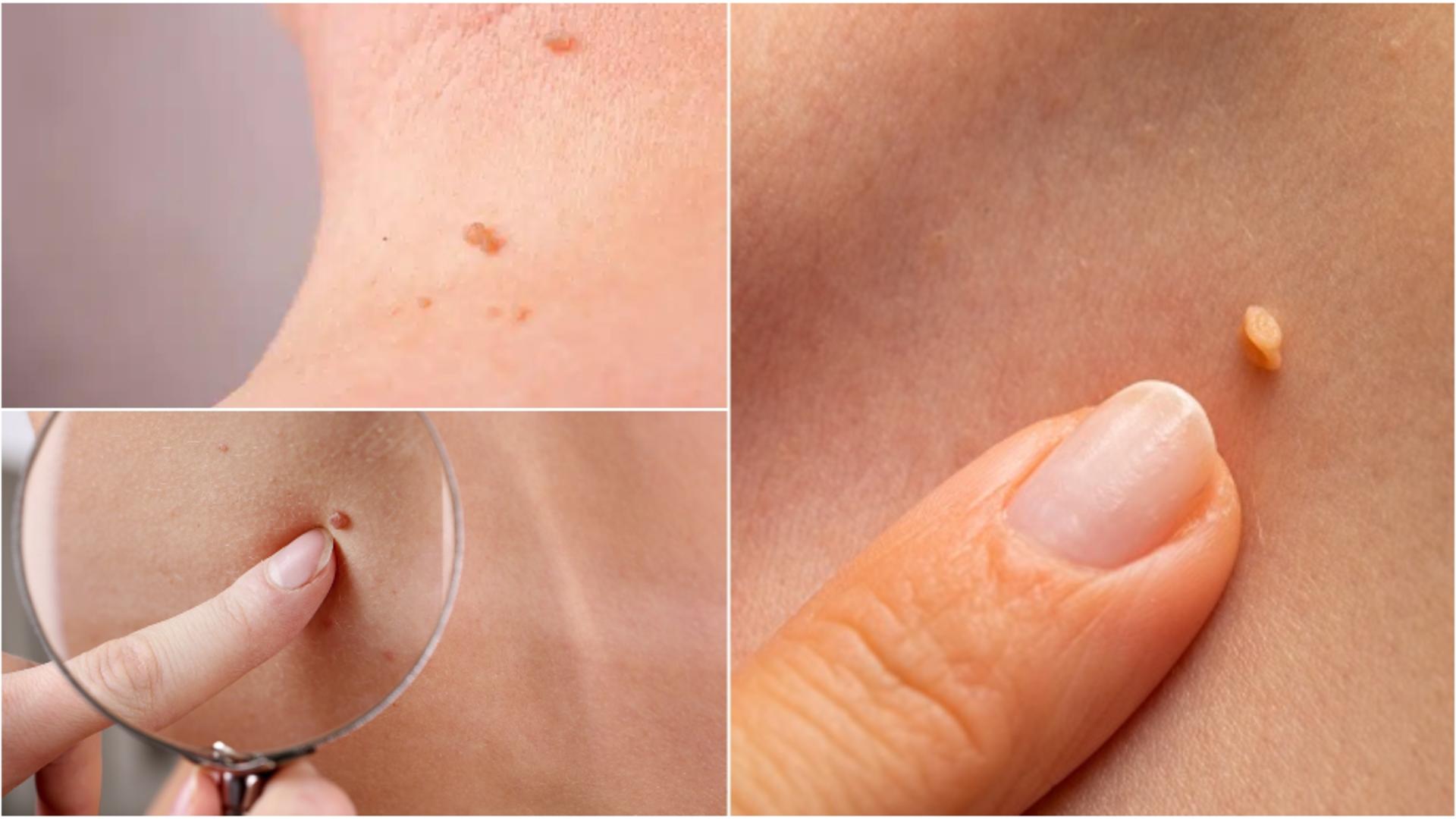 Ce sunt papiloamele și cât de periculoase pot fi