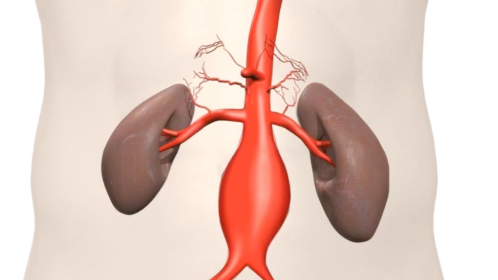 Cum se repară minim invaziv anevrismul de aortă