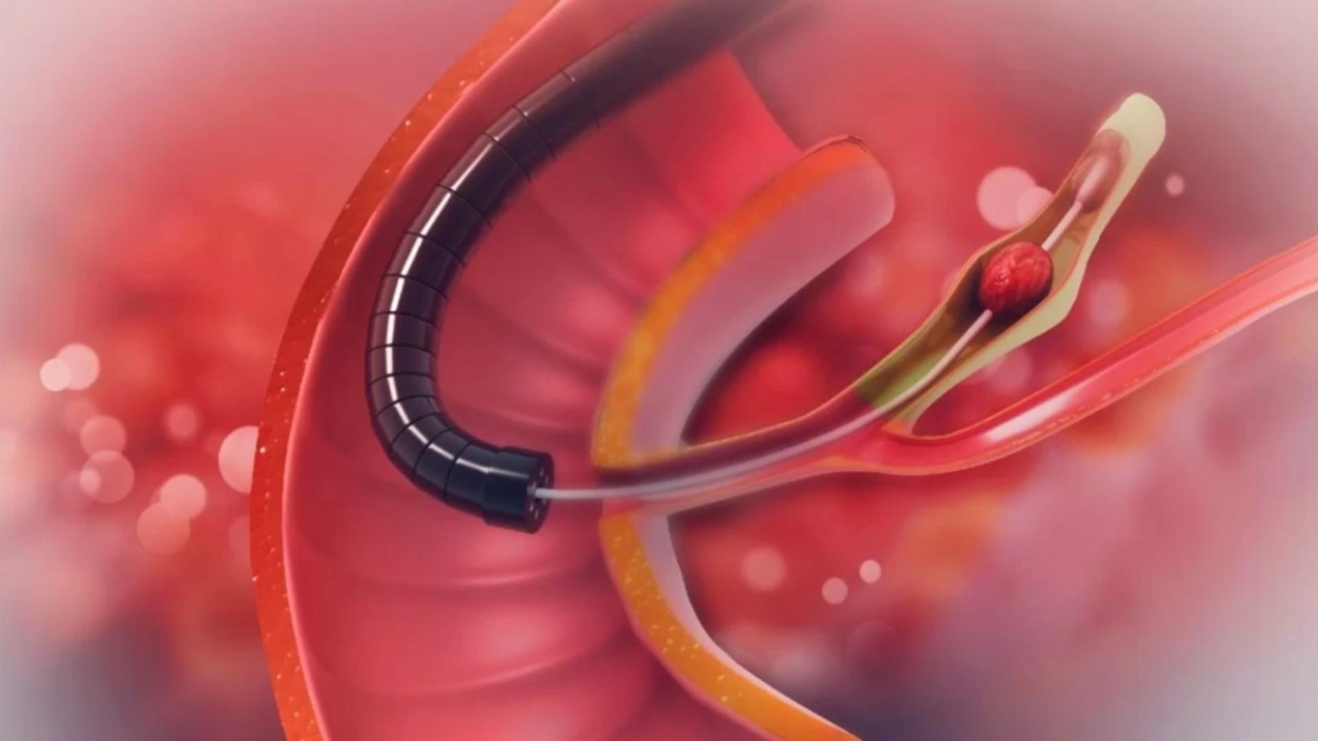 Operația recomandată pentru pietrele la fiere