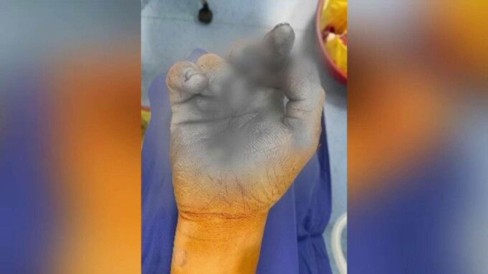 Incident în Brăila: doi copii răniți în urma exploziei unei petarde