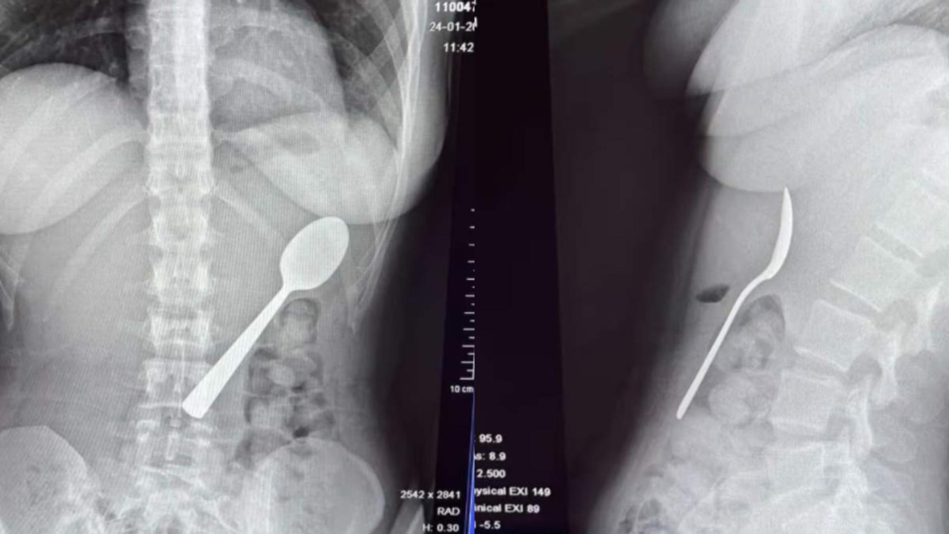 Lingură înghițită