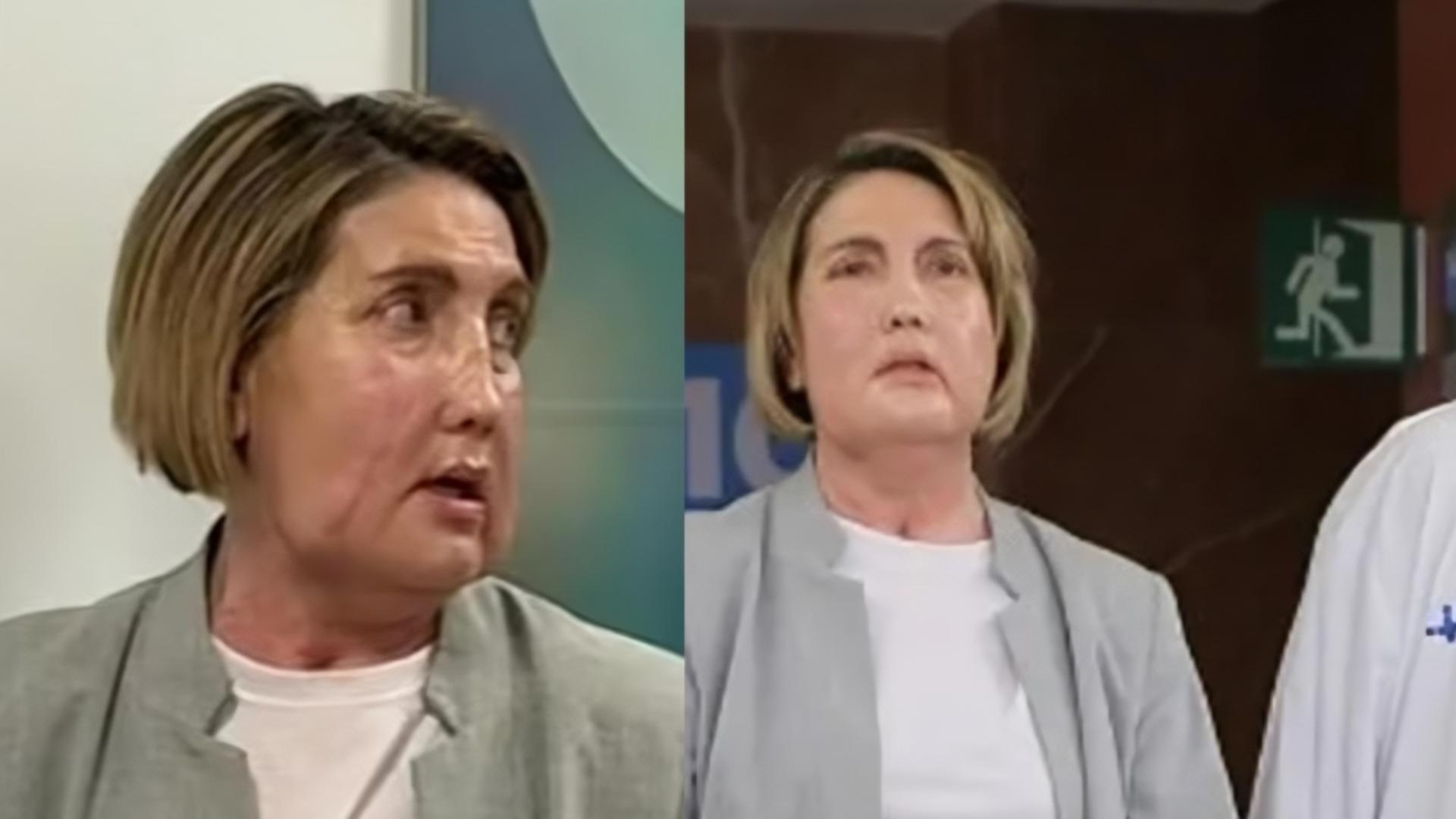 Premieră medicală în Spania. Medicii au realizat un transplant total de față de la o femeie care a ales eutanasierea.